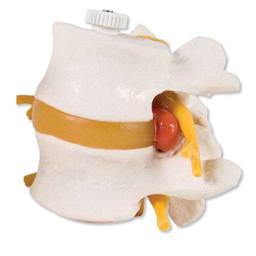 Prolaps, lumbalsegment 